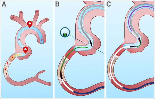 Figure 5 - tip in.jpg?itok=